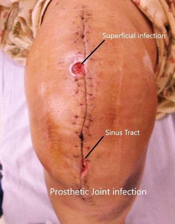 Surgery risks