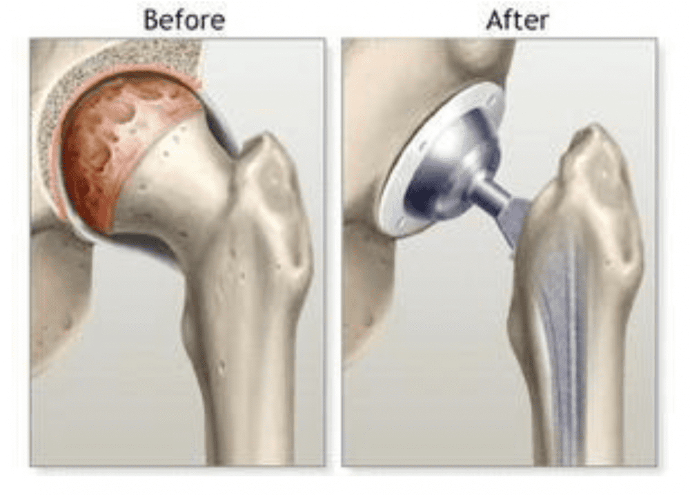 DAA Hip Replacement