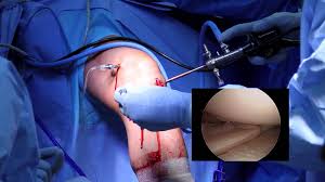 ACL Reconstruction